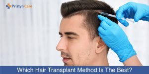 Which-Hair-Transplant-Method-Is-The-Best