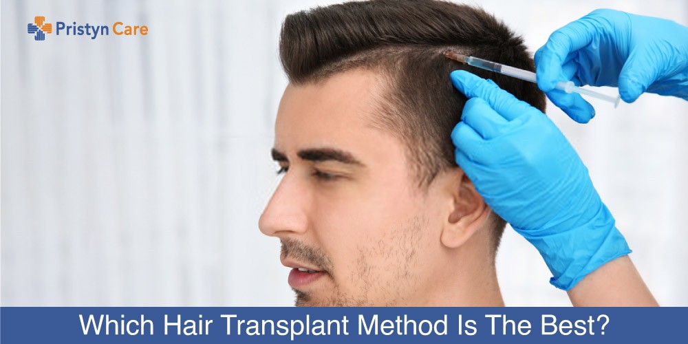 Which Hair Transplant Method is Best? - Pristyn Care