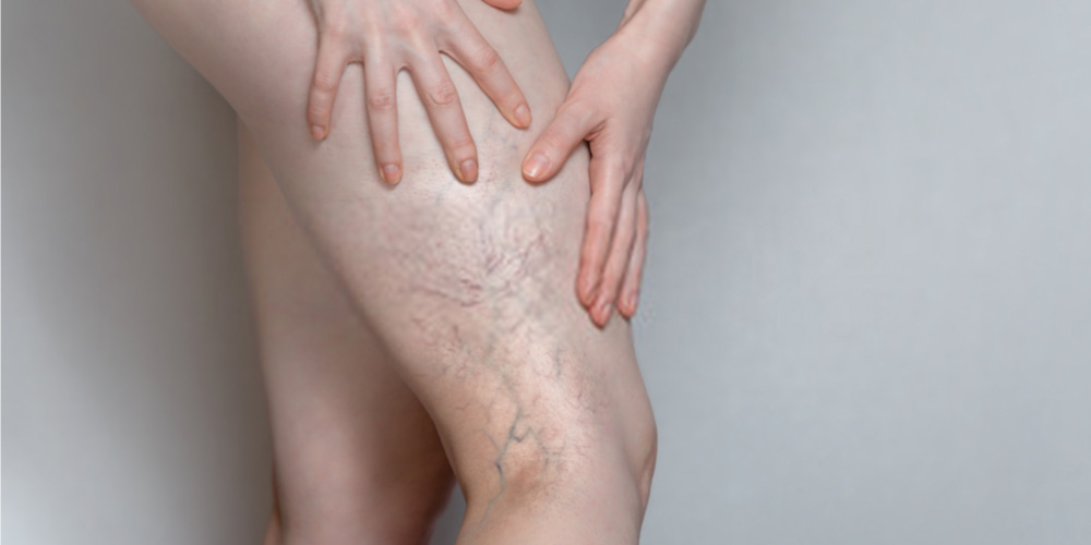 female with varicose veins in legs