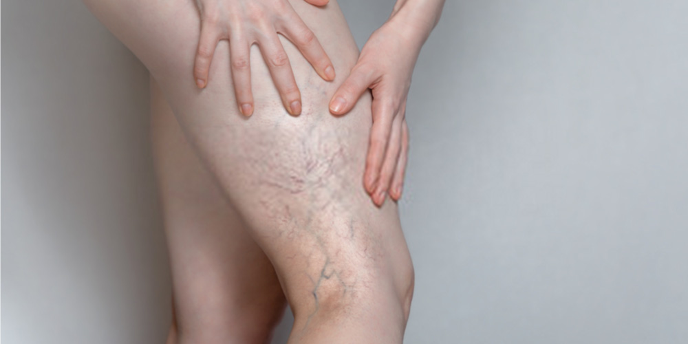 varicose veins in the legs