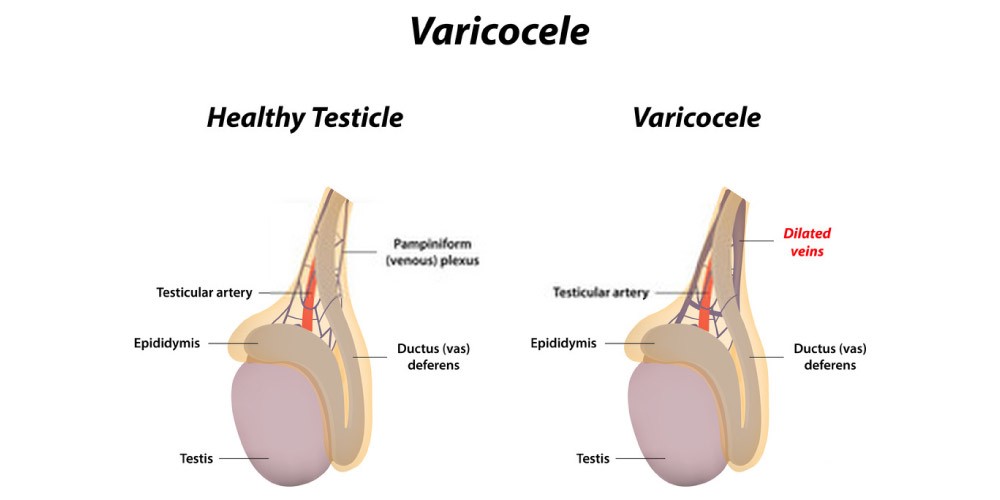 healthy testes and varicocele affected testes