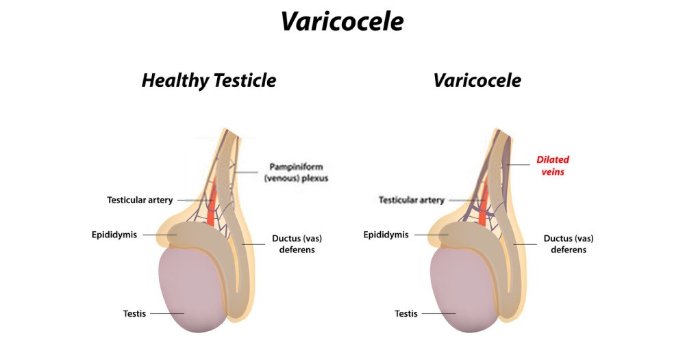 exerciii care împiedica varicosele