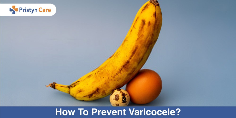 how to prevent varicocele