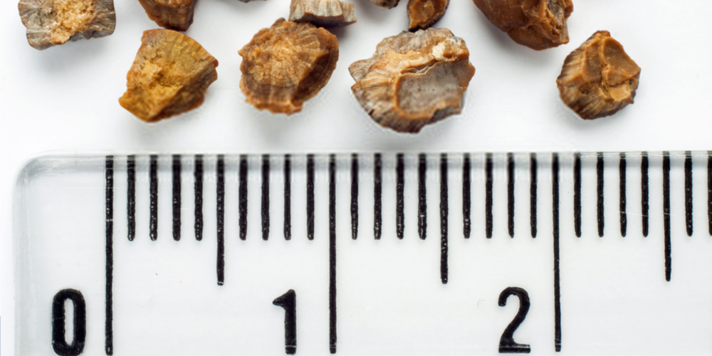actual kidney stone size chart
