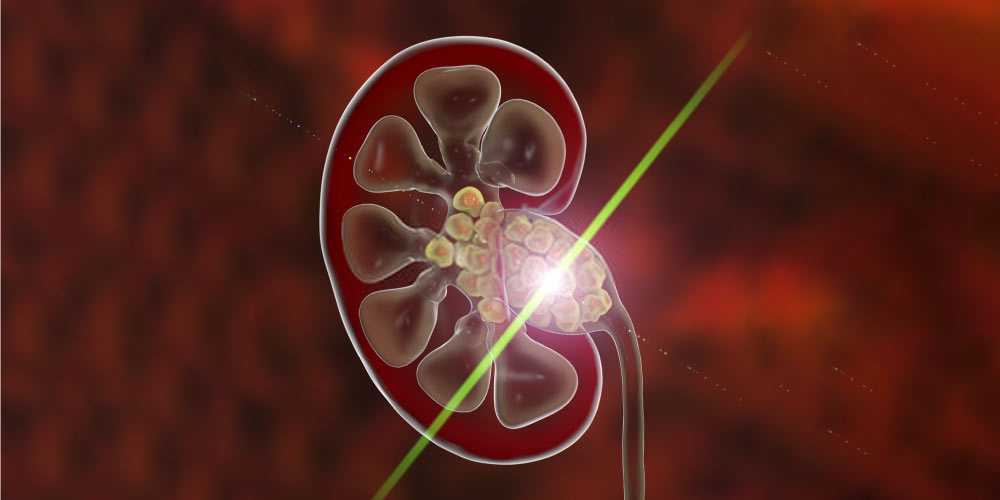 ureteroscopy with laser lithotripsy for kidney stone treatment