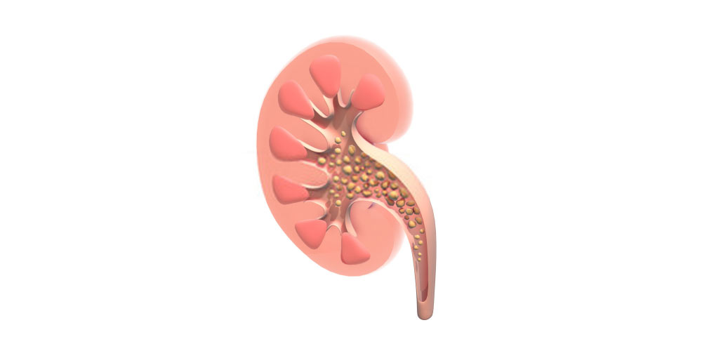kidney stones during pregnancy