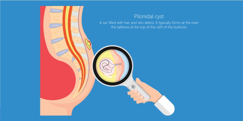 pilonidal cyst-cyst on the tailbone