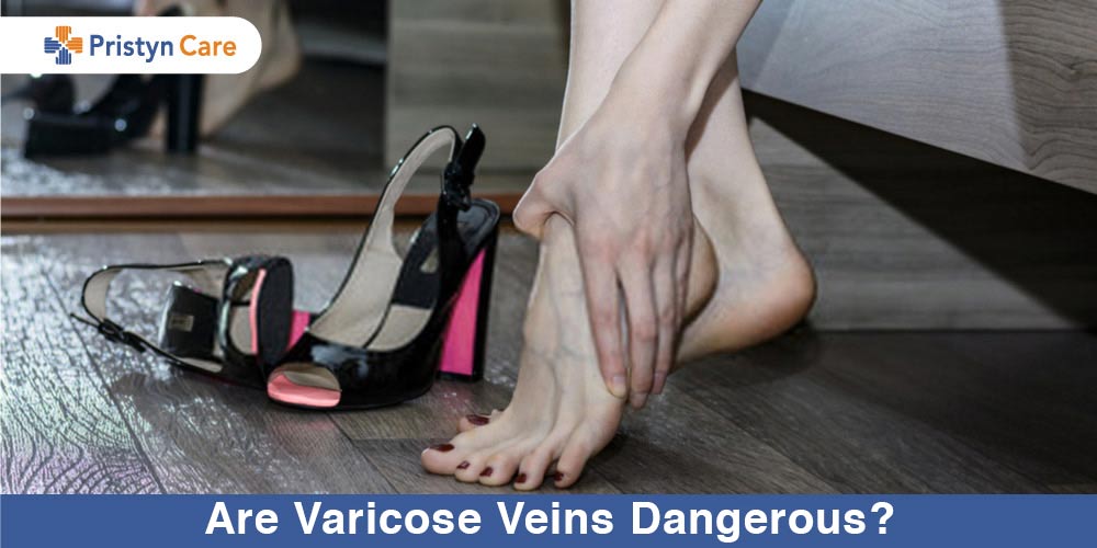 Are-Varicose-Veins-Dangerous