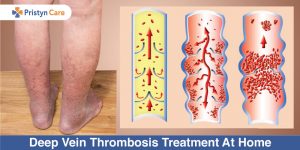 Deep-Vein-Thrombosis-Treatment-At-Home