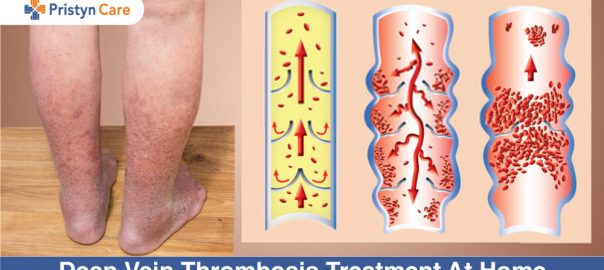 Deep Vein Thrombosis Treatment At Home