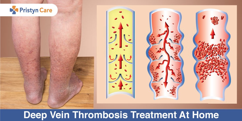 Deep-Vein-Thrombosis-Treatment-At-Home