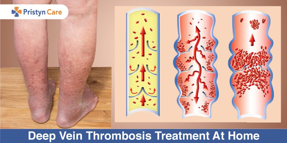 Deep Vein Thrombosis: Causes, Symptoms, Risk Factors, Diagnosis, Treatment,  Prevention and Complications