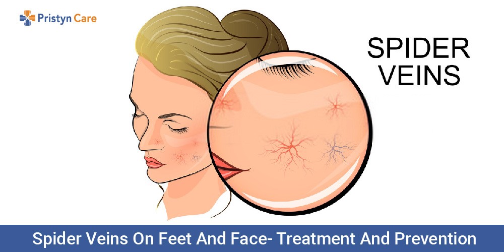 Can You Get Rid of Spider Veins Naturally? 