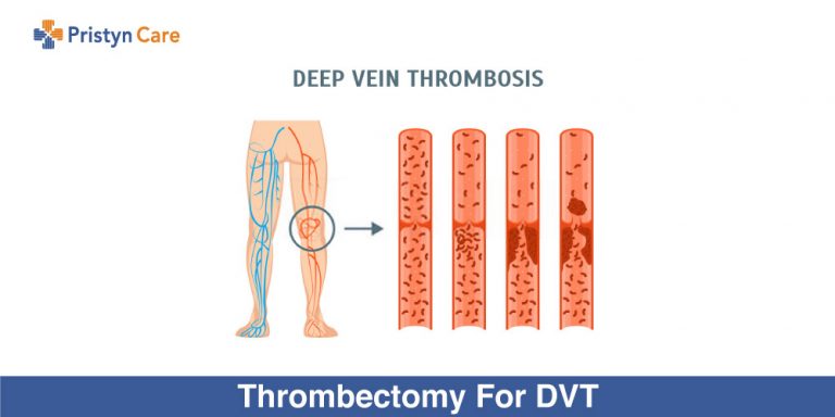 Thrombectomy-For-DVT