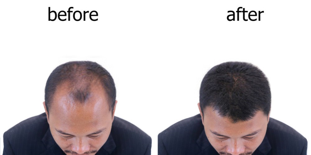 What is Male Pattern Baldness? What is Its Cure? Pristyn Care