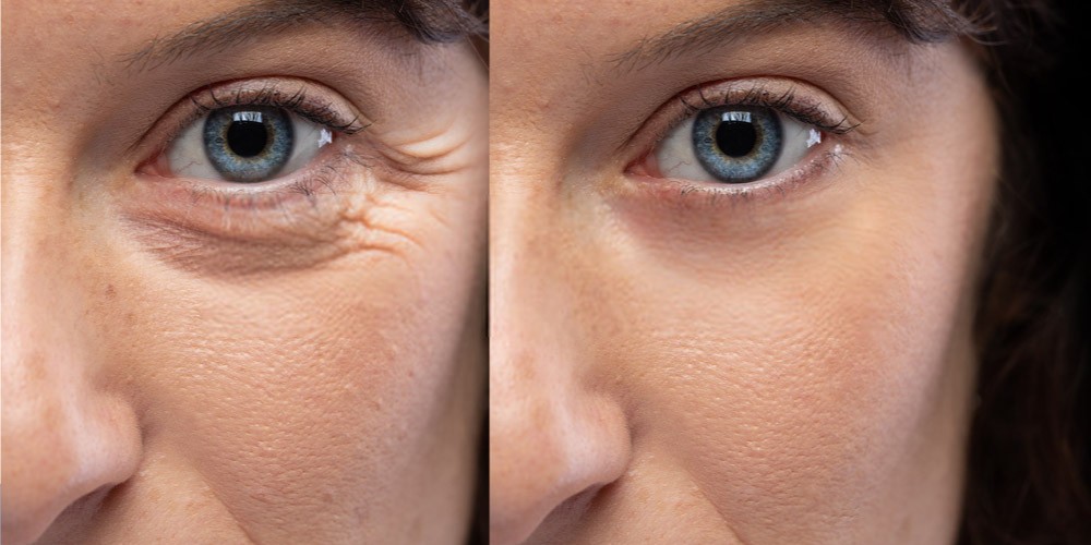 What is a Botox Injection? Pictures of Botox Before and After - Pristyn