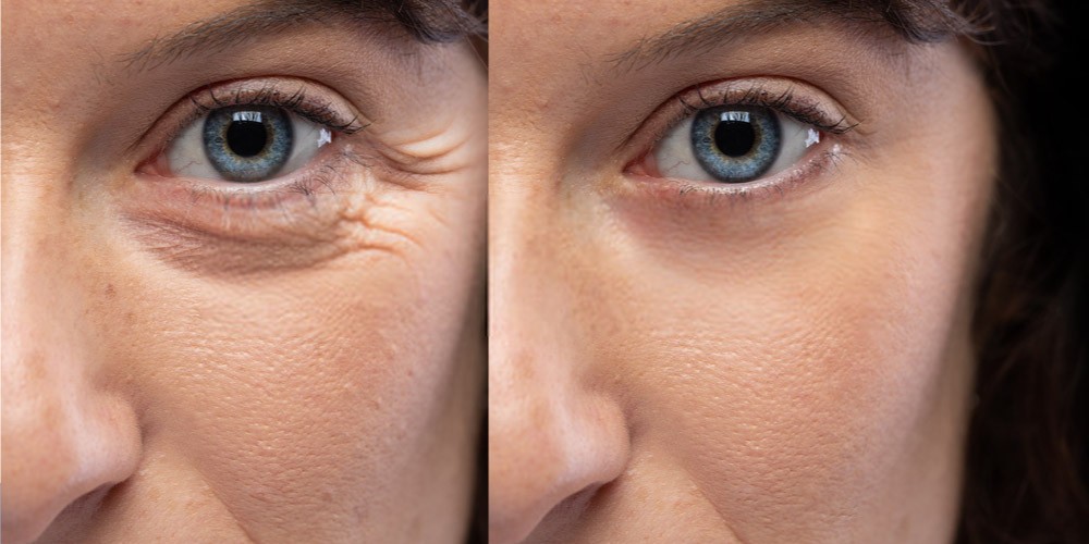 What is a Botox Injection? Pictures of Botox Before and After Pristyn