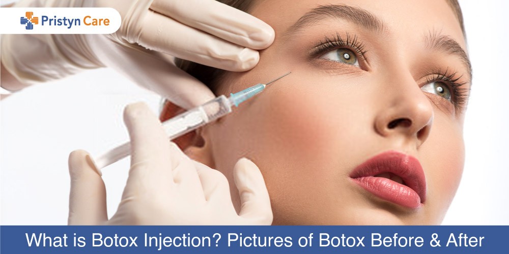What-is-Botox-Injection--Pictures-of-Botox-Before-and-After