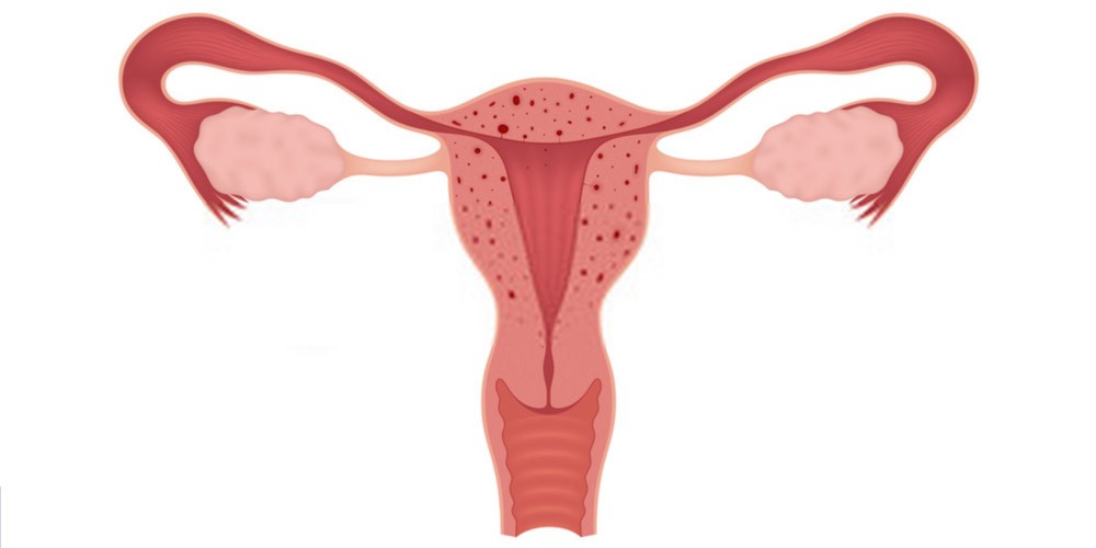 adenomyosis-enlargement of the uterus