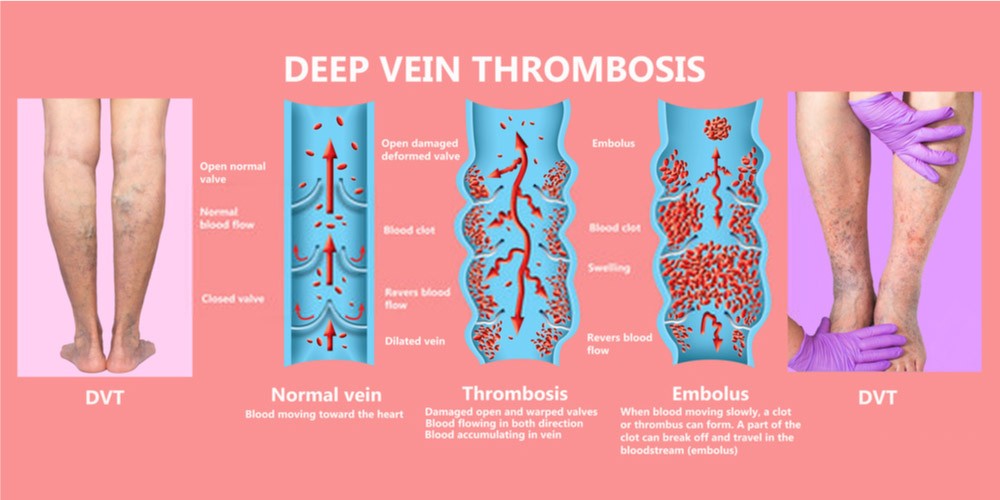 deep vein thrombosis in legs- DVT complication