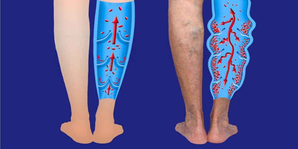 Lower Leg Pain And Swelling Causes And Treatment Pristyn Care