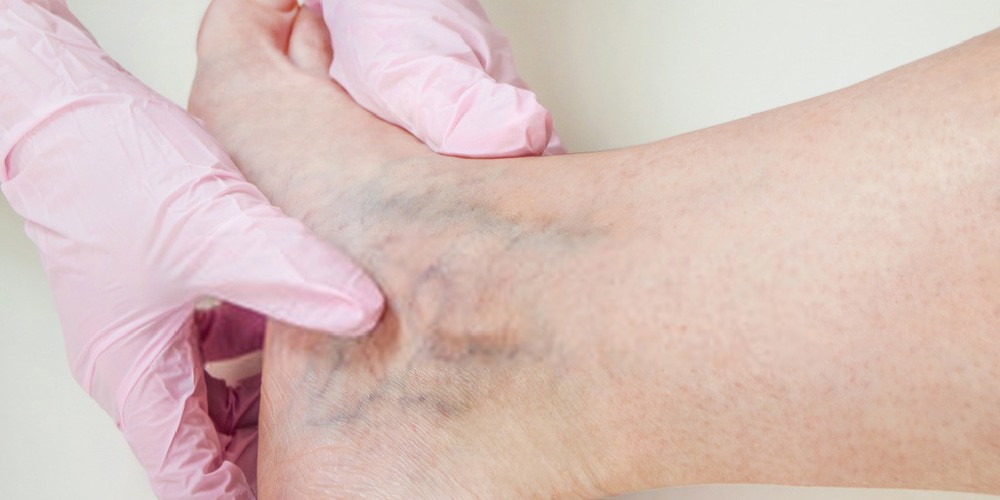 spider veins in the feet