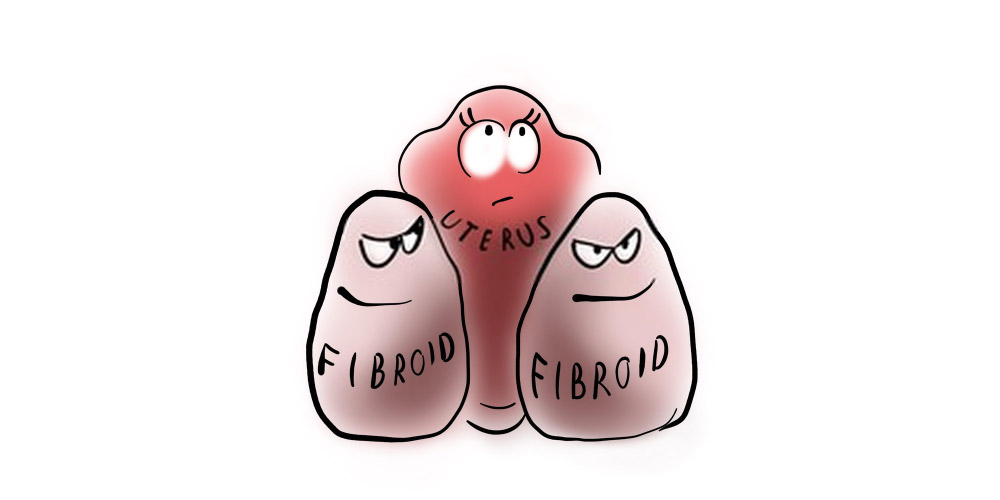 uterine fibroids causing menstrual pain