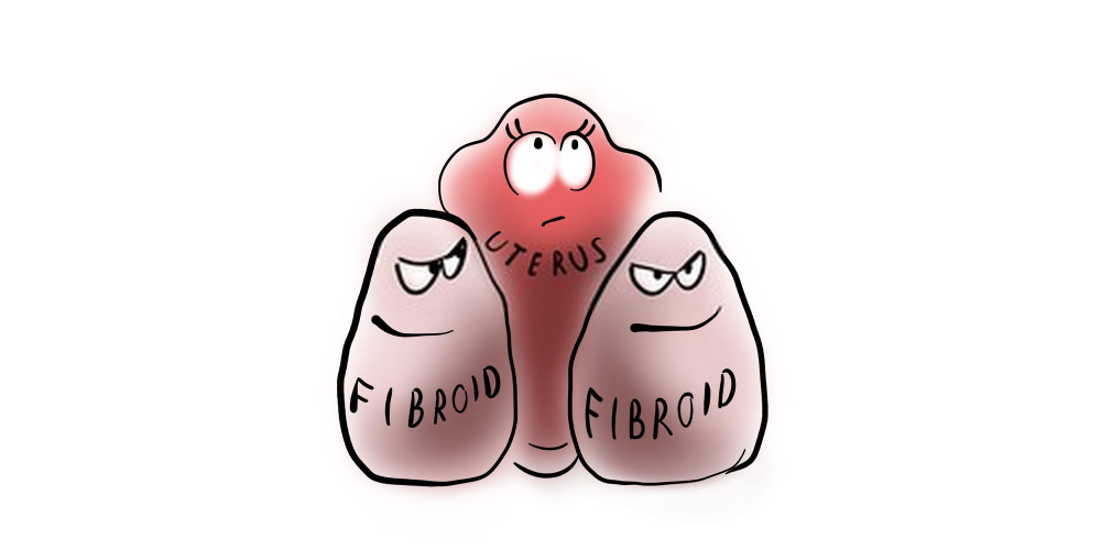 uterine fibroids causing menstrual pain