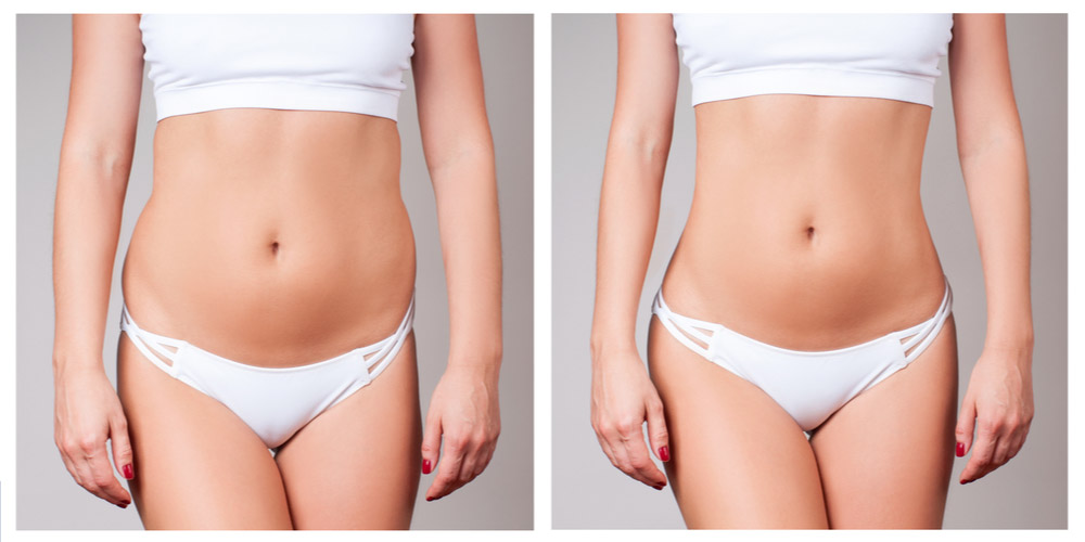 Before-and-After-Results-Abdomen-Liposuction