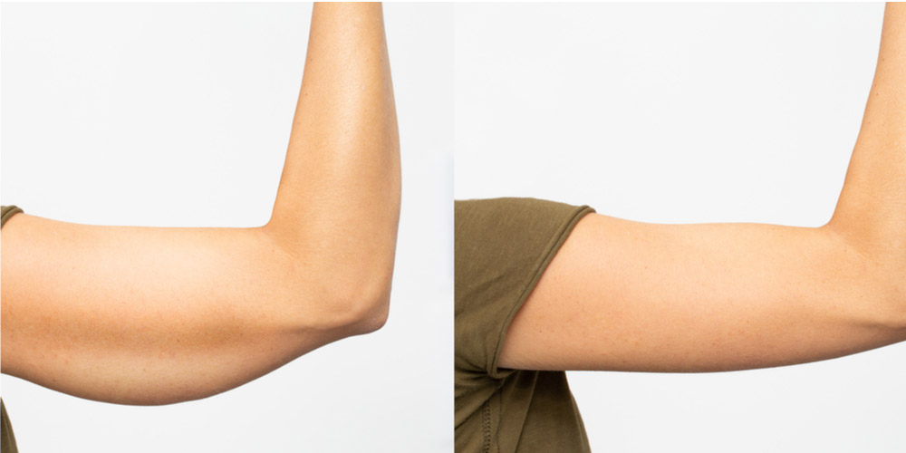 Before-and-After-Results-Arm-Liposuction
