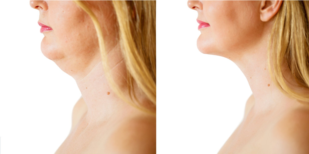 Before-and-After-Results-Chin-Liposuction
