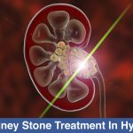 Best-Kidney-Stone-Treatment-In-Hyderabad