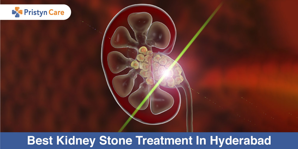 Best-Kidney-Stone-Treatment-In-Hyderabad