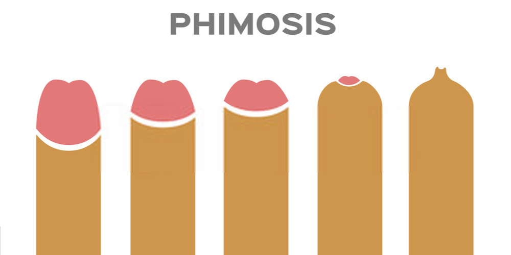 stages of phimosis 