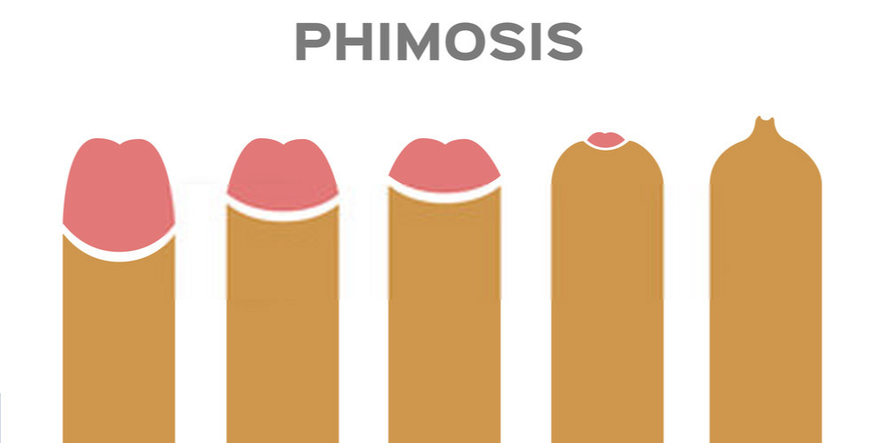 What are the treatment options for phimosis?