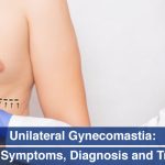Unilateral-Gynecomastia-Causes,-Symptoms,-Diagnosis-and-Treatment