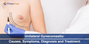 Unilateral-Gynecomastia-Causes,-Symptoms,-Diagnosis-and-Treatment