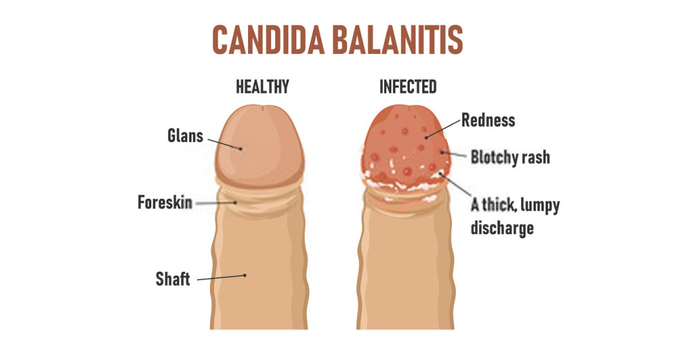 candida balanitis-inflammation of the penis