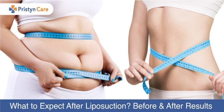 What-to-Expect-After-Liposuction-Before-and-After-Results