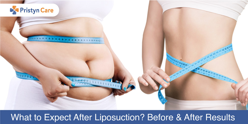 Dr Trussler Liposuction Austin