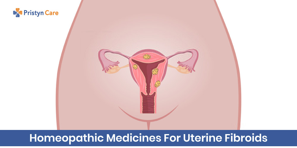 homeopathic treatment for uterine fibroids