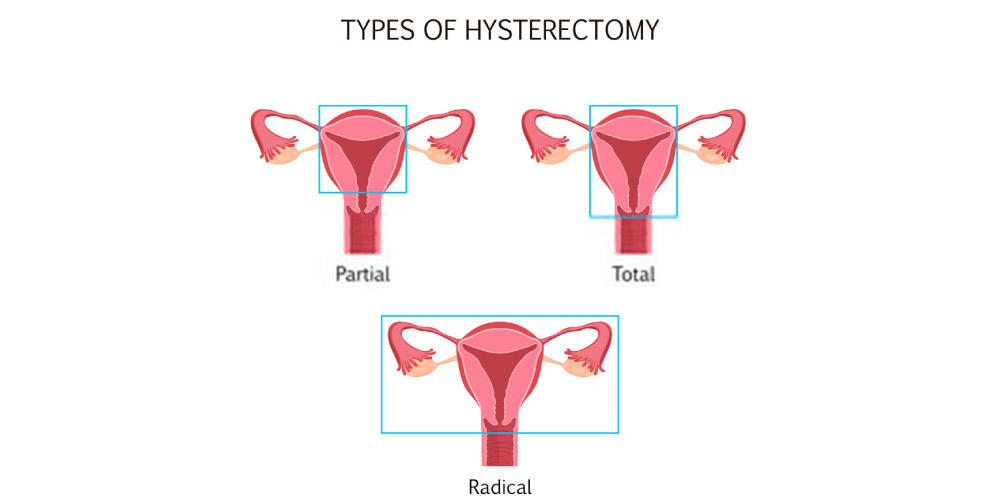 types of hysterectomy- uterine fibroids treatment