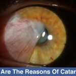 what-are-the-reasons-of-cataract