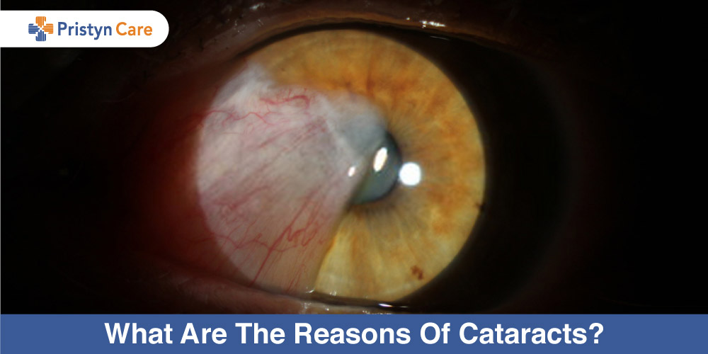 What Are The Reasons Of Cataract? Pristyn Care