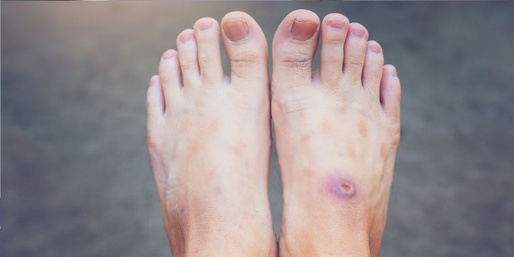 Diabetes and Foot Pain Know The Reason And Tips For Care