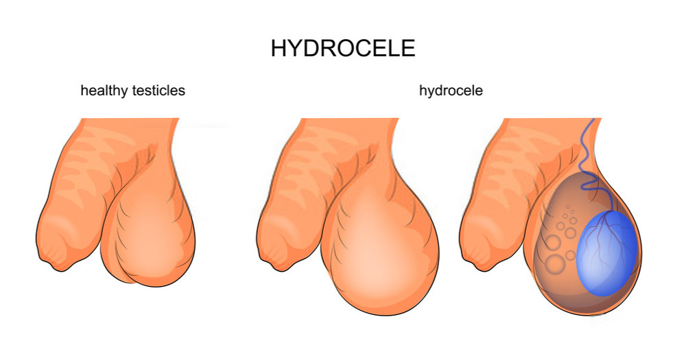 hydrocele affected testes