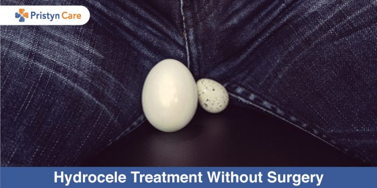 Hydrocele-Treatment-Without-Surgery