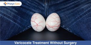 Varicocele-Treatment-Without-Surgery