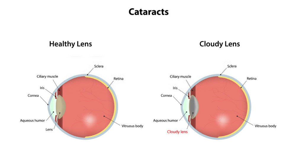 normal eye vs cataract