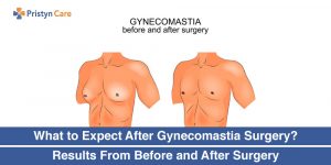 What-to-Expect-After-Gynecomastia-Surgery-Results-From-Before-and-After-Surgery